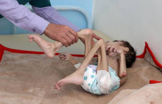 Yemeni boy, ravaged by hunger, weighs 7 kg