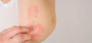 Understanding Psoriasis: A Common Skin Condition